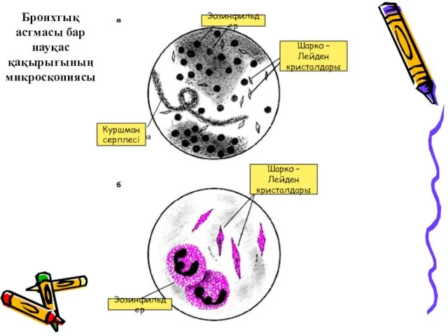 Эозинфильдер Шарко –Лейден кристалдары Куршман серппесі Шарко –Лейден кристалдары Эозинфильдер Бронхтық астмасы бар науқас қақырығының микроскопиясы