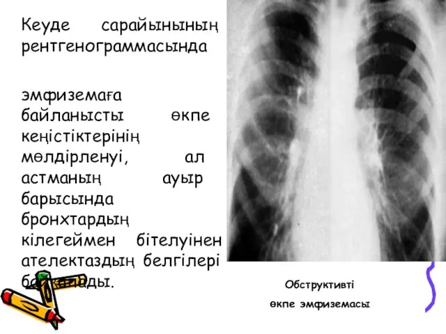 Кеуде сарайынының рентгенограммасында эмфиземаға байланысты өкпе кеңістіктерінің мөлдірленуі, ал астманың ауыр барысында бронхтардың