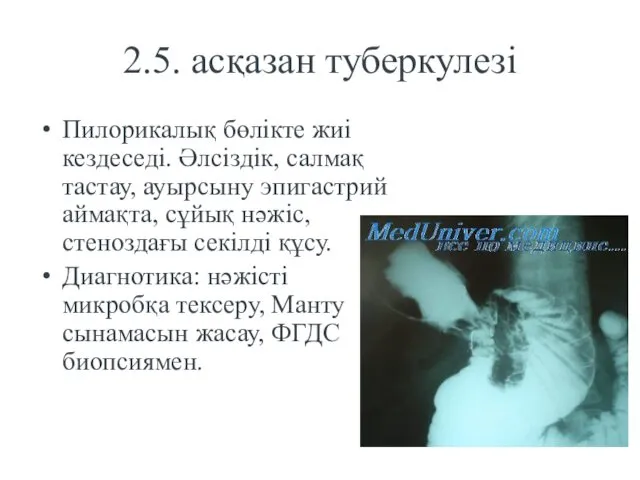 2.5. асқазан туберкулезі Пилорикалық бөлікте жиі кездеседі. Әлсіздік, салмақ тастау,