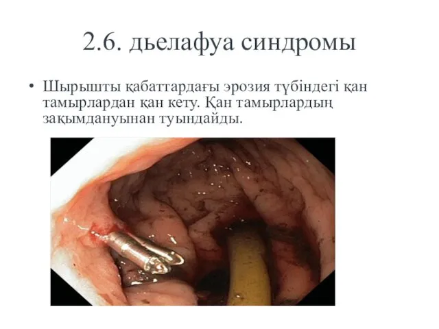 2.6. дьелафуа синдромы Шырышты қабаттардағы эрозия түбіндегі қан тамырлардан қан кету. Қан тамырлардың зақымдануынан туындайды.