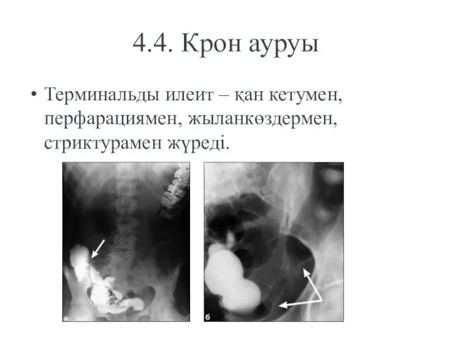 4.4. Крон ауруы Терминальды илеит – қан кетумен, перфарациямен, жыланкөздермен, стриктурамен жүреді.