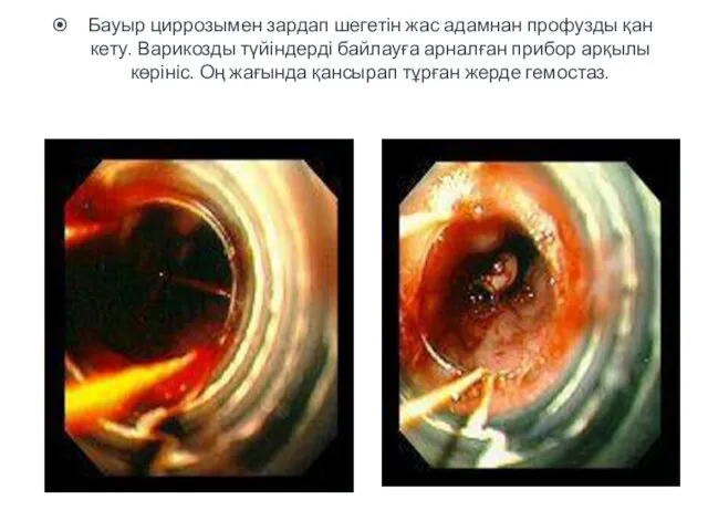 Бауыр циррозымен зардап шегетін жас адамнан профузды қан кету. Варикозды