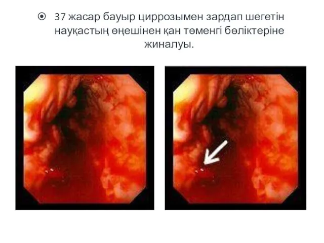 37 жасар бауыр циррозымен зардап шегетін науқастың өңешінен қан төменгі бөліктеріне жиналуы.