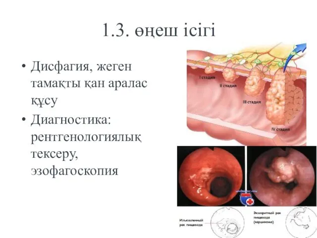 1.3. өңеш ісігі Дисфагия, жеген тамақты қан аралас құсу Диагностика: рентгенологиялық тексеру, эзофагоскопия