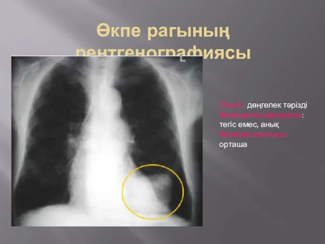 Өкпе рагының рентгенографиясы Пішіні : дөңгелек тәрізді Көлеңкенің шекарасы: тегіс емес, анық Көлеңке қоюлығы: орташа