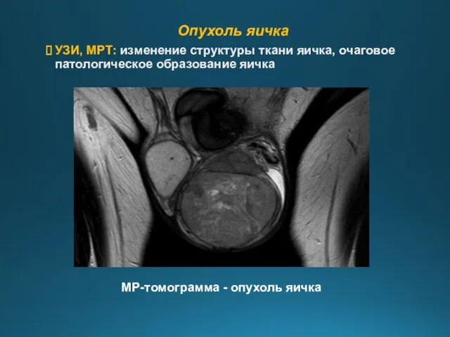 Опухоль яичка УЗИ, МРТ: изменение структуры ткани яичка, очаговое патологическое образование яичка МР-томограмма - опухоль яичка