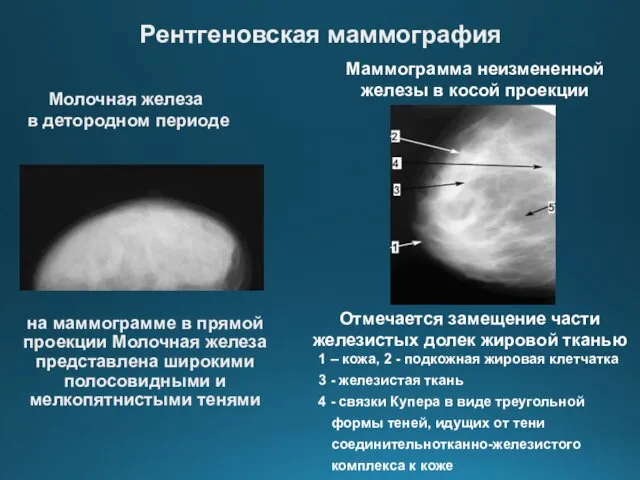 на маммограмме в прямой проекции Молочная железа представлена широкими полосовидными