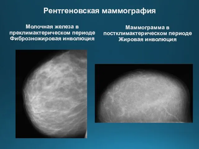 Молочная железа в преклимактерическом периоде Фиброзножировая инволюция Маммограмма в постклимактерическом периоде Жировая инволюция Рентгеновская маммография