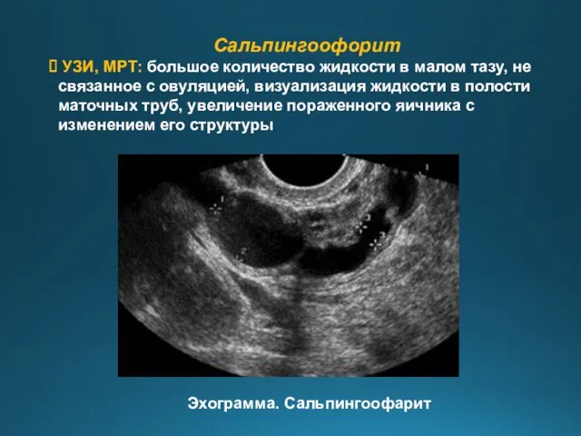 Сальпингоофорит УЗИ, МРТ: большое количество жидкости в малом тазу, не