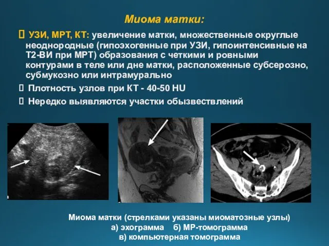 Миома матки: УЗИ, МРТ, КТ: увеличение матки, множественные округлые неоднородные