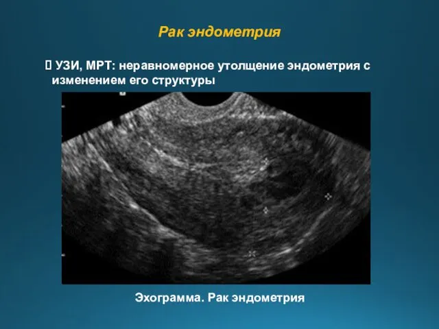 Рак эндометрия УЗИ, МРТ: неравномерное утолщение эндометрия с изменением его структуры Эхограмма. Рак эндометрия