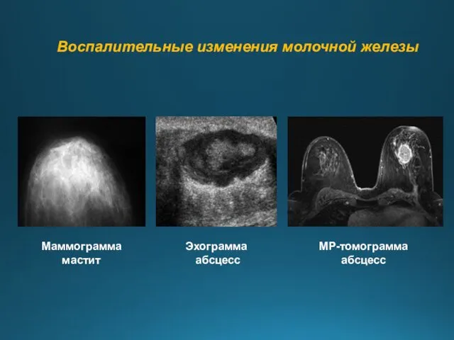 Воспалительные изменения молочной железы МР-томограмма абсцесс Маммограмма мастит Эхограмма абсцесс
