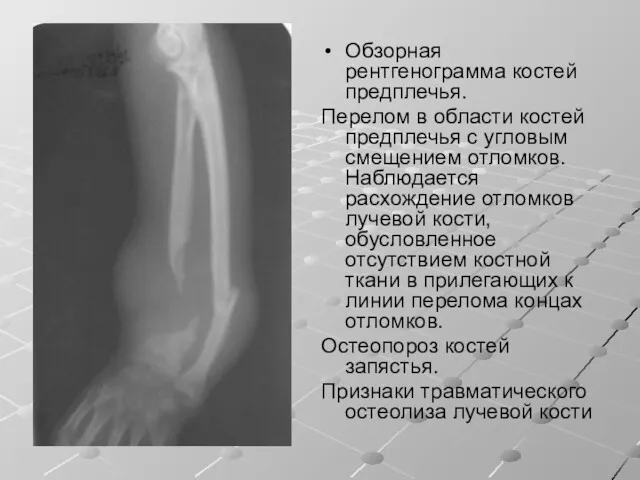Обзорная рентгенограмма костей предплечья. Перелом в области костей предплечья с угловым смещением отломков.