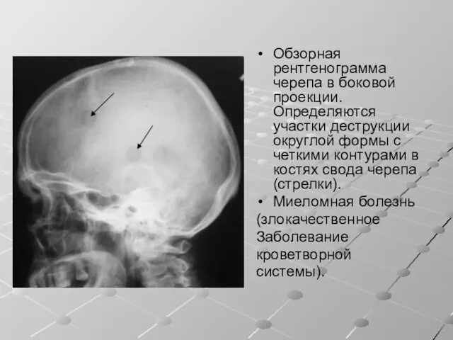 Обзорная рентгенограмма черепа в боковой проекции. Определяются участки деструкции округлой формы с четкими