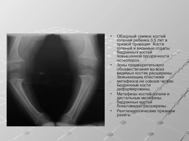 Обзорный снимок костей голеней ребенка 3,5 лет в прямой проекции. Кости голеней и