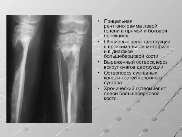 Прицельная рентгенограмма левой голени в прямой и боковой проекциях. Обширные зоны деструкции в
