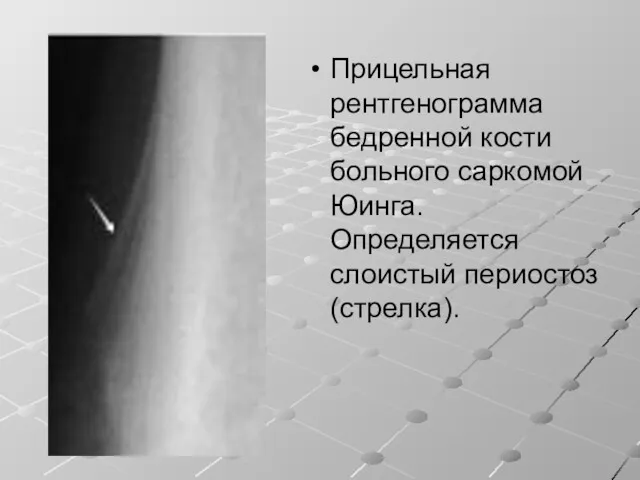 Прицельная рентгенограмма бедренной кости больного саркомой Юинга. Определяется слоистый периостоз (стрелка).