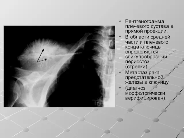 Рентгенограмма плечевого сустава в прямой проекции. В области средней части и плечевого конца