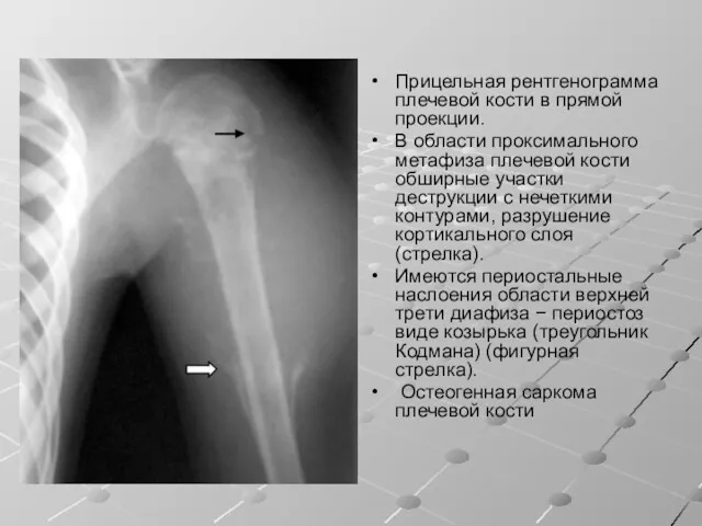 Прицельная рентгенограмма плечевой кости в прямой проекции. В области проксимального метафиза плечевой кости