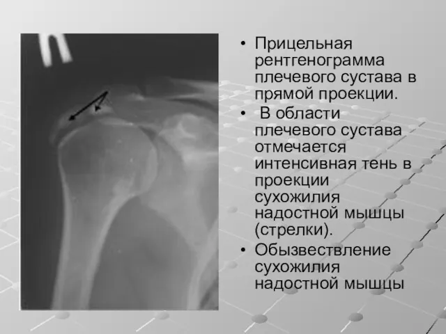 Прицельная рентгенограмма плечевого сустава в прямой проекции. В области плечевого сустава отмечается интенсивная