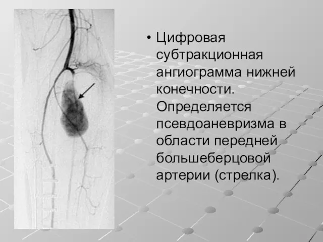 Цифровая субтракционная ангиограмма нижней конечности. Определяется псевдоаневризма в области передней большеберцовой артерии (стрелка).
