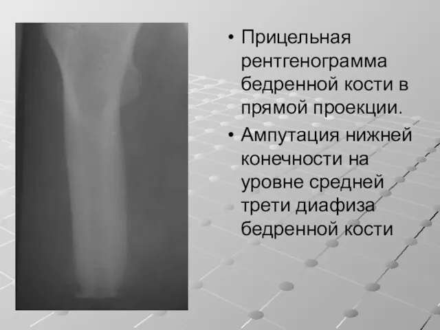 Прицельная рентгенограмма бедренной кости в прямой проекции. Ампутация нижней конечности на уровне средней