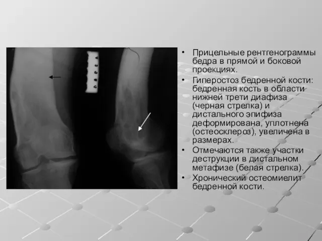 Прицельные рентгенограммы бедра в прямой и боковой проекциях. Гиперостоз бедренной кости: бедренная кость