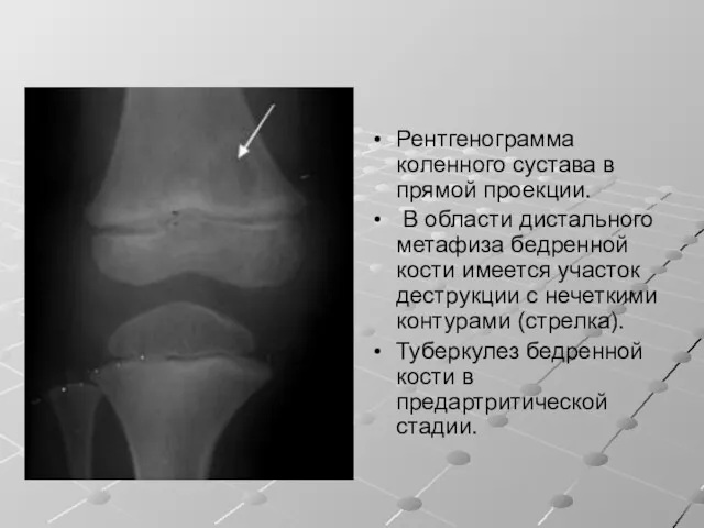 Рентгенограмма коленного сустава в прямой проекции. В области дистального метафиза бедренной кости имеется