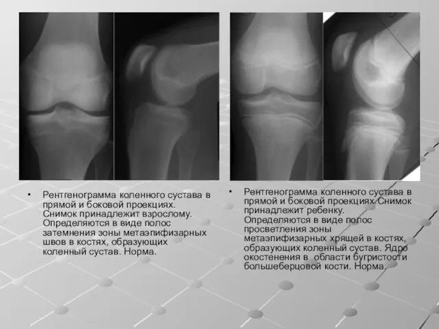 Рентгенограмма коленного сустава в прямой и боковой проекциях. Снимок принадлежит взрослому. Определяются в