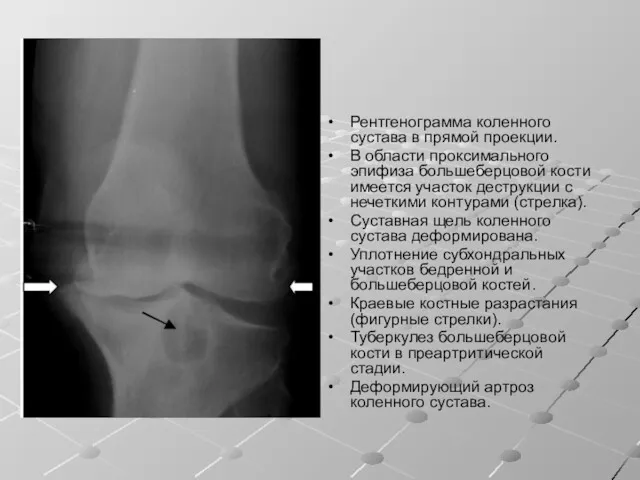 Рентгенограмма коленного сустава в прямой проекции. В области проксимального эпифиза большеберцовой кости имеется