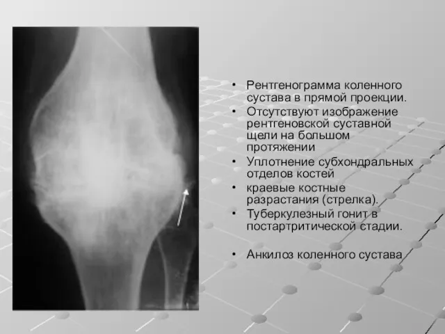 Рентгенограмма коленного сустава в прямой проекции. Отсутствуют изображение рентгеновской суставной щели на большом
