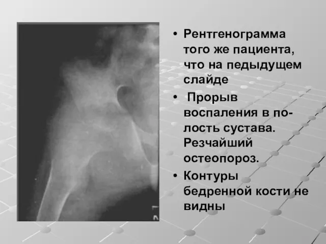 Рентгенограмма того же пациента, что на педыдущем слайде Прорыв воспаления в по-лость сустава.