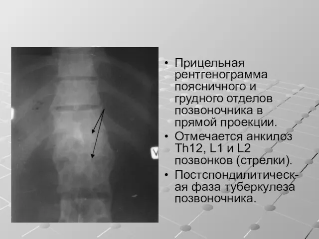 Прицельная рентгенограмма поясничного и грудного отделов позвоночника в прямой проекции. Отмечается анкилоз Th12,