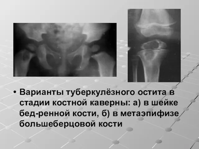 Варианты туберкулёзного остита в стадии костной каверны: а) в шейке бед-ренной кости, б)