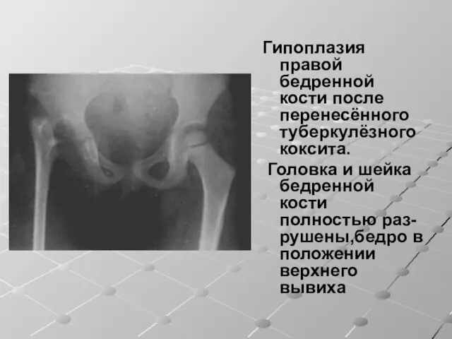 Гипоплазия правой бедренной кости после перенесённого туберкулёзного коксита. Головка и шейка бедренной кости