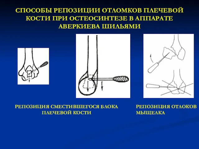 СПОСОБЫ РЕПОЗИЦИИ ОТЛОМКОВ ПЛЕЧЕВОЙ КОСТИ ПРИ ОСТЕОСИНТЕЗЕ В АППАРАТЕ АВЕРКИЕВА