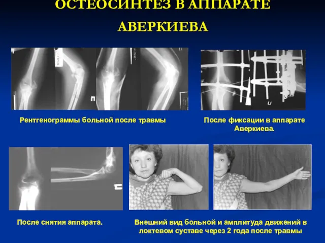 ОСТЕОСИНТЕЗ В АППАРАТЕ АВЕРКИЕВА Рентгенограммы больной после травмы После фиксации