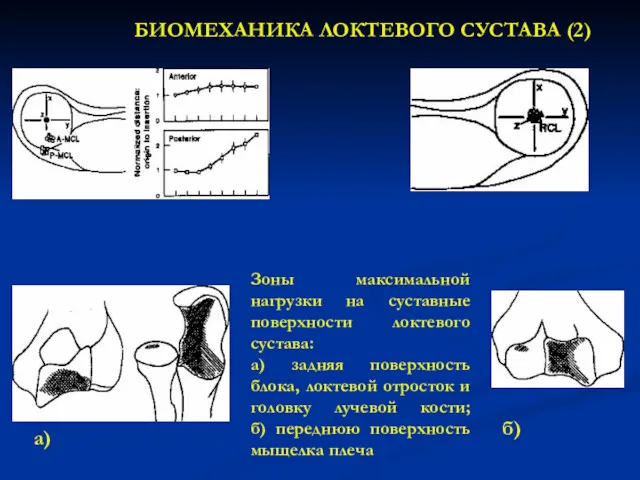 Зоны максимальной нагрузки на суставные поверхности локтевого сустава: а) задняя