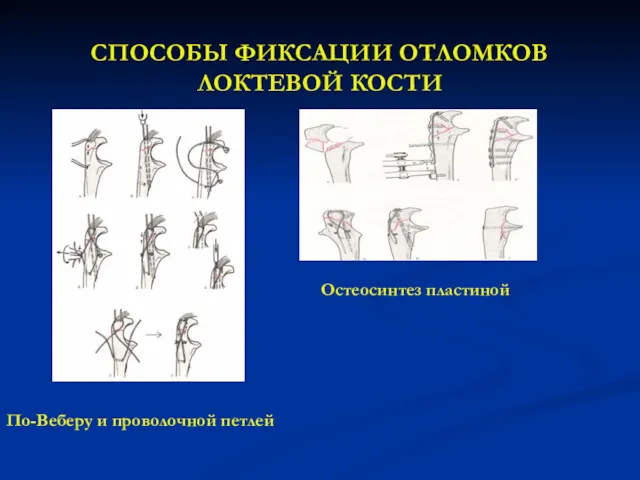 СПОСОБЫ ФИКСАЦИИ ОТЛОМКОВ ЛОКТЕВОЙ КОСТИ По-Веберу и проволочной петлей Остеосинтез пластиной