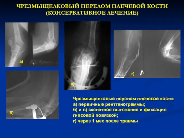 ЧРЕЗМЫЩЕЛКОВЫЙ ПЕРЕЛОМ ПЛЕЧЕВОЙ КОСТИ (КОНСЕРВАТИВНОЕ ЛЕЧЕНИЕ) а) б) в) г)