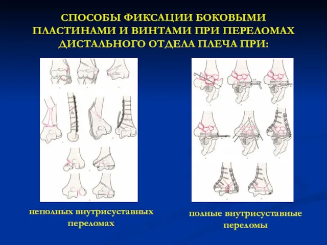 СПОСОБЫ ФИКСАЦИИ БОКОВЫМИ ПЛАСТИНАМИ И ВИНТАМИ ПРИ ПЕРЕЛОМАХ ДИСТАЛЬНОГО ОТДЕЛА