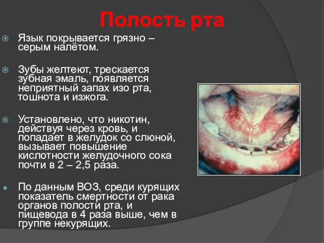 Полость рта Язык покрывается грязно – серым налётом. Зубы желтеют,