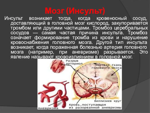 Мозг (Инсульт) Инсульт возникает тогда, когда кровеносный сосуд, доставляющий в