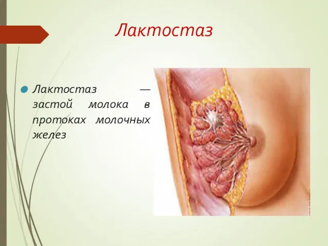 Лактостаз Лактостаз — застой молока в протоках молочных желез