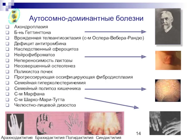 Copyright L. Gerasimova 2007 Ахондроплазия Б-нь Геттингтона Врожденная телеангиоэктазия (с-м