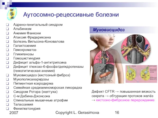 Copyright L. Gerasimova 2007 Аутосомно-рецессивные болезни Адрено-генитальный синдром Альбинизм Анемия