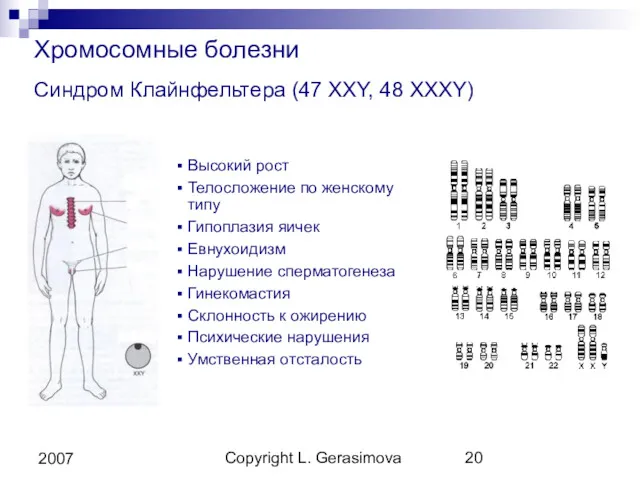 Copyright L. Gerasimova 2007 Хромосомные болезни Синдром Клайнфельтера (47 XXY,