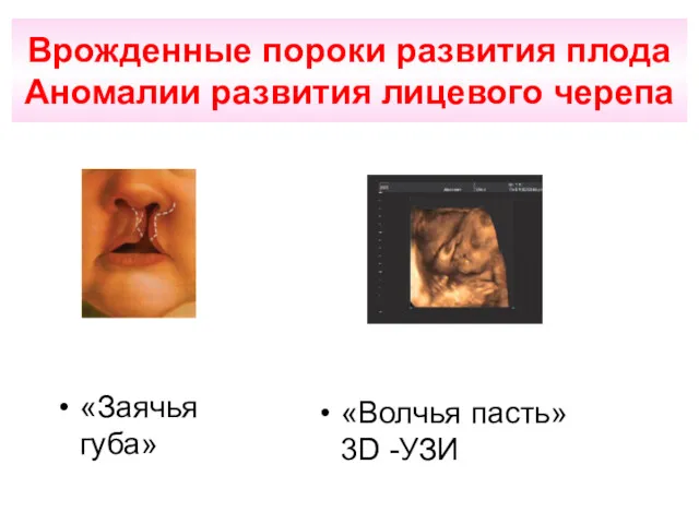 Врожденные пороки развития плода Аномалии развития лицевого черепа «Заячья губа» «Волчья пасть» 3D -УЗИ