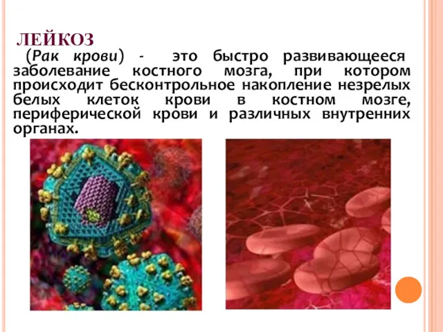 ЛЕЙКОЗ (Рак крови) - это быстро развивающееся заболевание костного мозга,