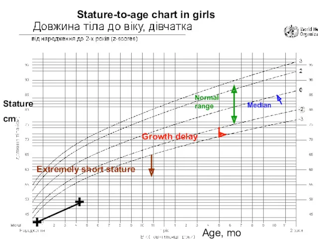 Median Growth delay Normalrange Extremely short stature + + Stature cm Age, mo